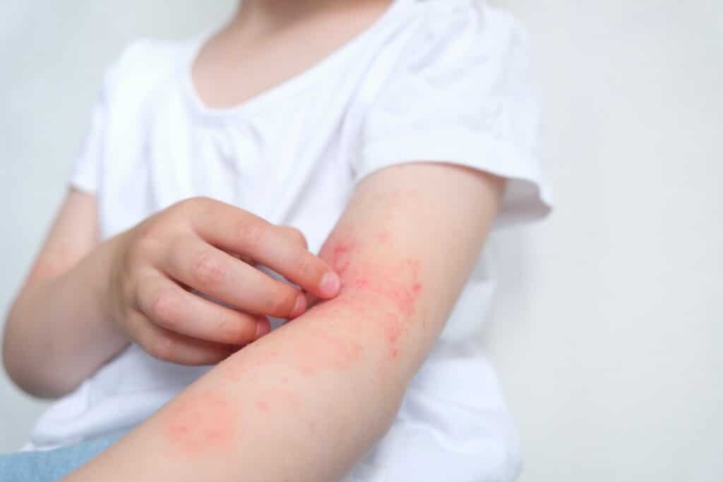 A kid with an allergic reaction to paint, scratching their irritated red skin, showcasing the potential effects of direct contact with paint allergens.